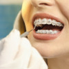traitement-orthodontiste-acide-hyaluronique-scaled-1